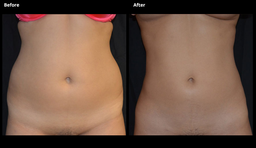 Liposuction used for fat reduction and body sculpting. - Barbarino