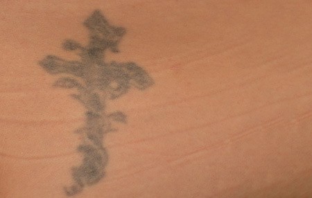 TattooRemoval_Before_2-1