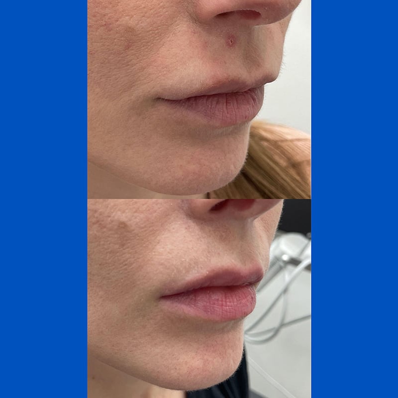 Lip Filler Before and After Correction 22