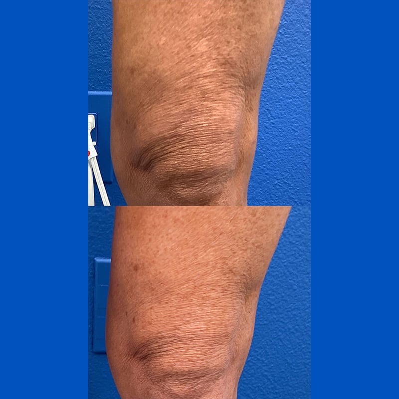 UltraSlim 3 Before and After