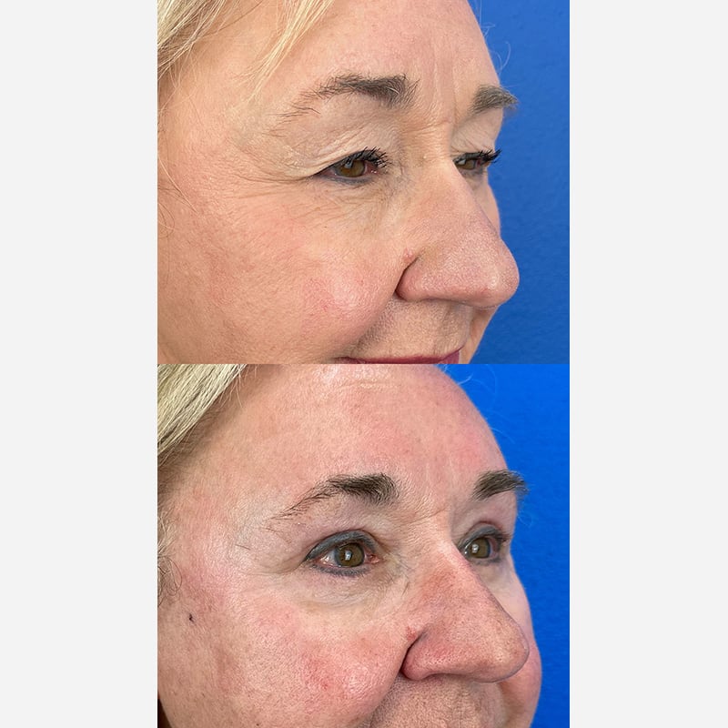 This patient had an upper blepharoplasty/eyelid surgery with browpexy & lower blepharoplasty/eyelid surgery Before & After