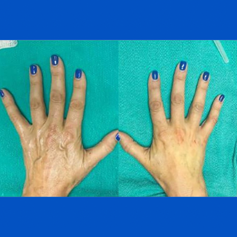 hands before and after injections