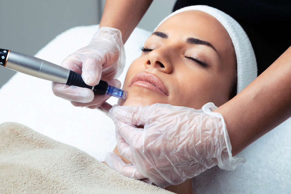 Microneedling With SkinPen in Austin