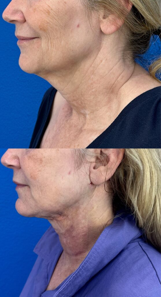 elevate with renuvion neck lift before and after