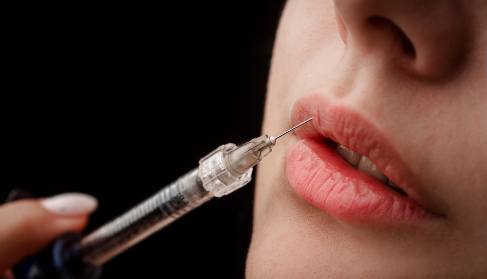 Where to Find the Best Lip Filler Injections in Austin 