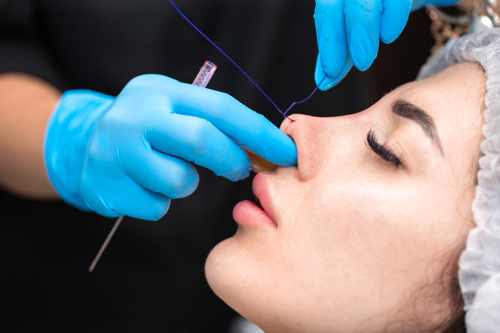 Non-Surgical Rhinoplasty with Thread Lifts
